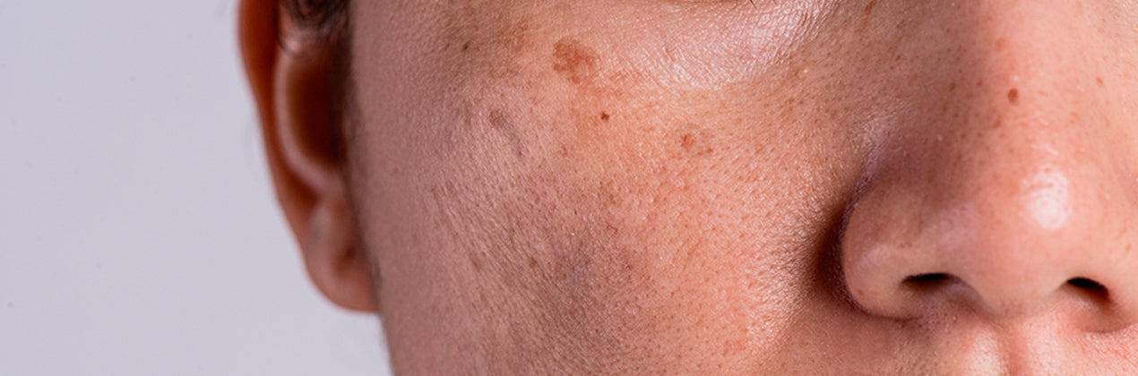 HYPERPIGMENTATION