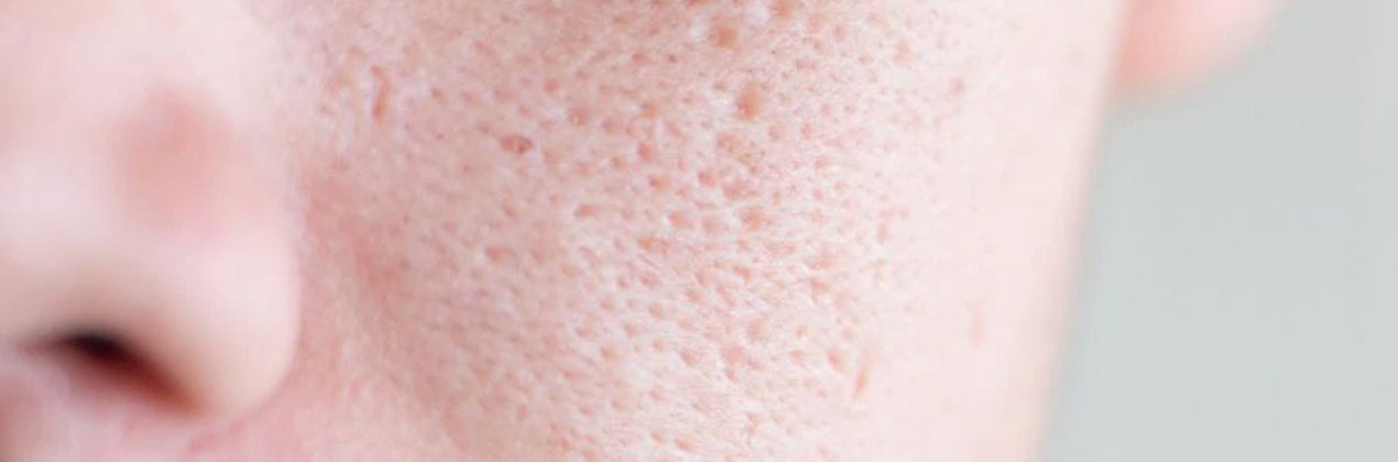 ENLARGED PORES
