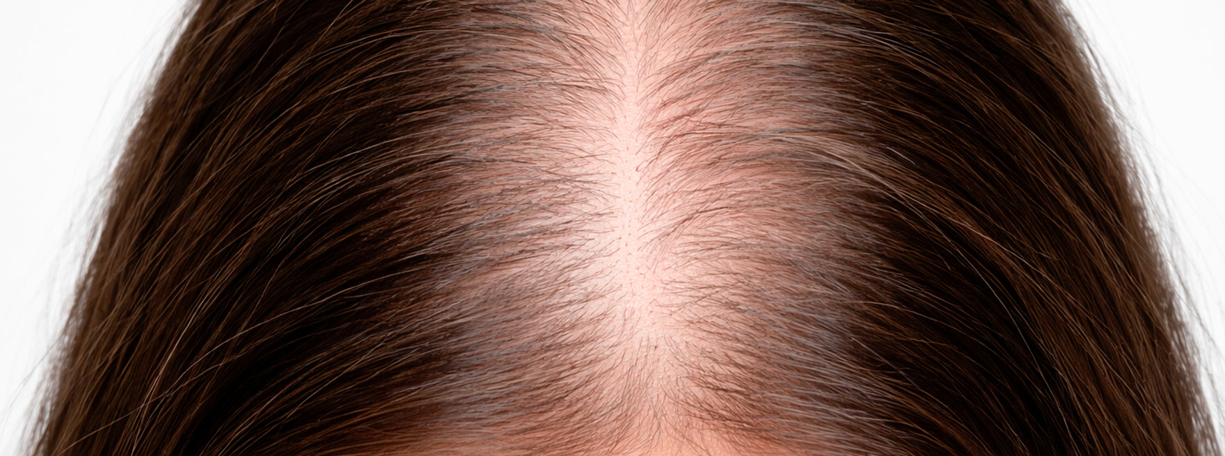HAIR LOSS